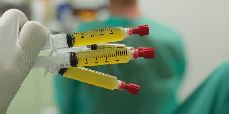 Bild zeigt Teaser Haartransplantation