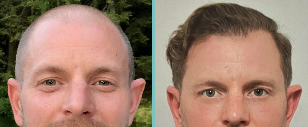 vorher-nachher-eric-d-1 vorher-nachher-eric-d-1