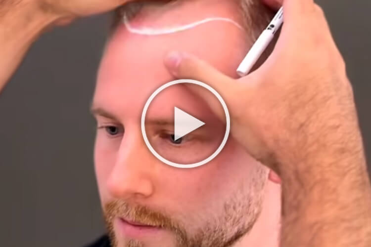 Bild zeigt Teaser Haartransplantation