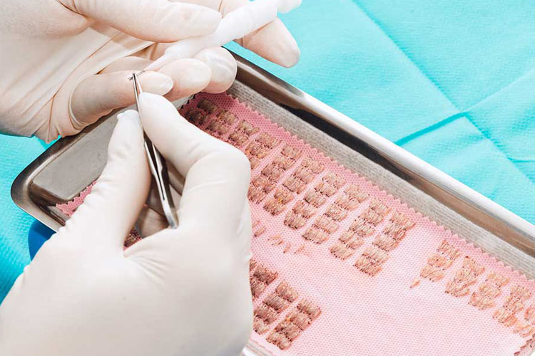 Petrischale mit Haarwurzeln aus der Entnahme